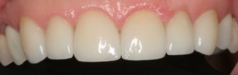 Porcelain Veneers and Crowns after 370188