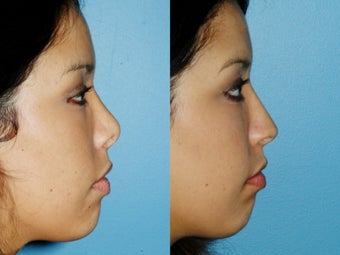 Revision rhinoplasty after 395565