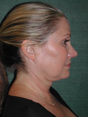 Female Facelift before 117062