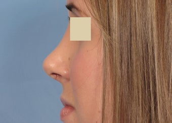Rhinoplasty after 112966