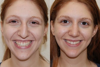 Rhinoplasty Surgery. 5 weeks post-op before 212791