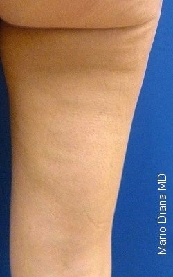 Cellulaze after 582366