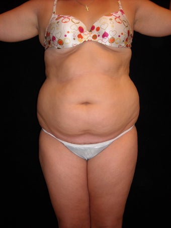 Liposuction of the trunk before 222563