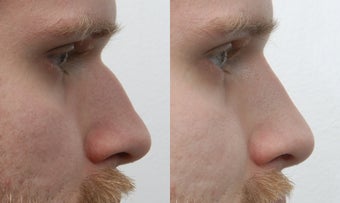 non-surgical rhinoplasty before 259258