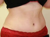 Abdominoplasty (Tummy Tuck) after 216672