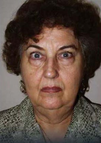 Refresher Facelift w/Neck Plication, Browllift, Upper & Lower Lids, Fat Injections to Cheeks & Lips before 252883