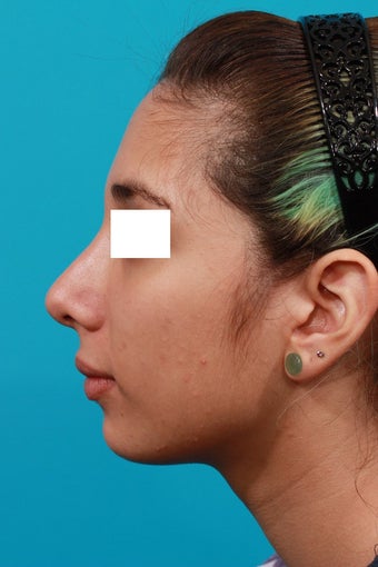 Closed Rhinoplasty after 134616