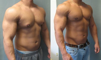 Gynecomastia Surgery 341129