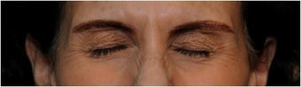 Botox before 66929