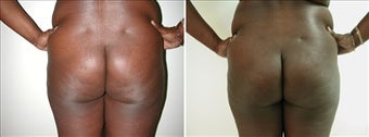 Buttock Enhancement before 110107