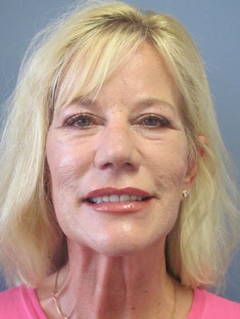 Neck Lift, Platysmaplasty before 634737