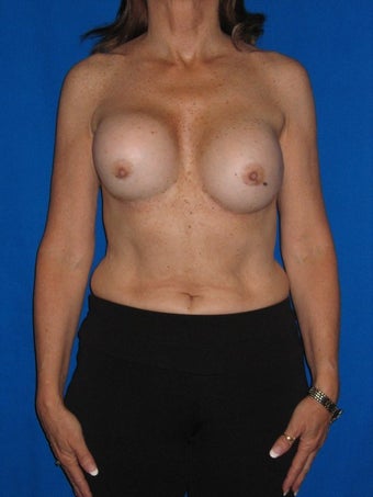Breast Augmentation Revision before 75974