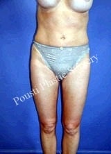 Liposuction after 634646