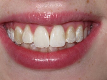Kor Whitening after 405631