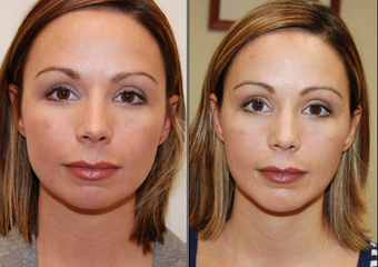 Chin Implant, frontal view before 95083
