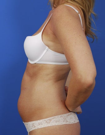 Laser Liposuction 364486
