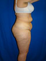 Extended Tummy Tuck, Liposuction, 495158