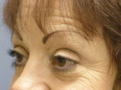 Brow Lift 541478