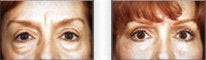 Upper and Lower Blepharoplasty before 88835