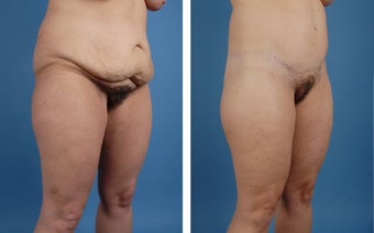 Lower Body Lift and Liposuction of Lateral Thighs 303681