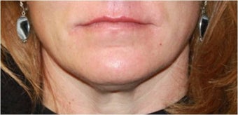 Lip augmentation - juvederm after 435618