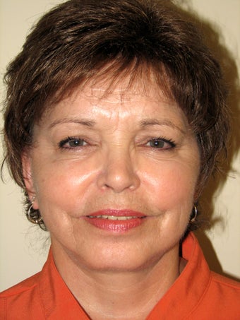 Natural Facelift and Necklift after 570610