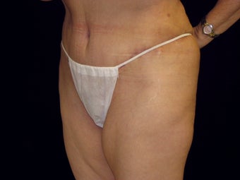Abdominoplasty after 258236