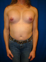 Transgender Surgery- Breast Implants after 131869