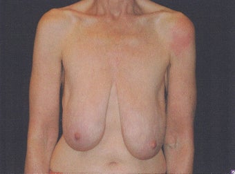 Breast lift (mastopexy) before 231596