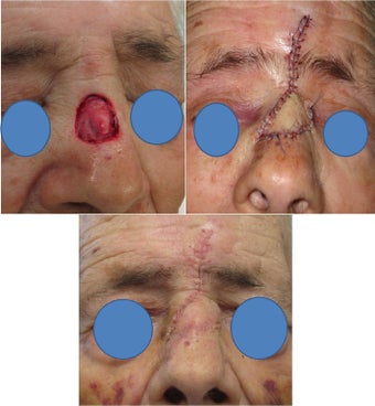 Nasal bridge defect repair after Mohs Surgery before 82509