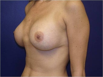 Breast Augmentation 427306