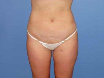 Tumescent liposuction before and after after 78800
