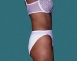 Tummy Tuck 542650