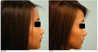 Asian Rhinoplasty before 136825