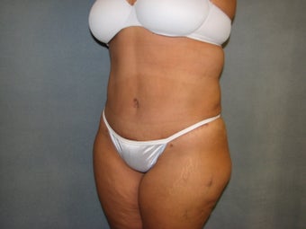 Tummy Tuck after 127655