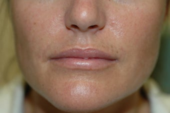 Perma Facial Implant after 340186
