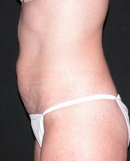 Tummy Tuck with Flank Liposuction 330911