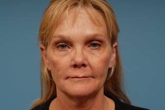 Sculptra, Restylane before 364322