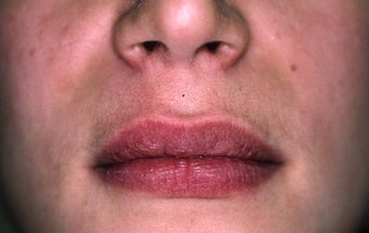 Lip Augmentation after 149213