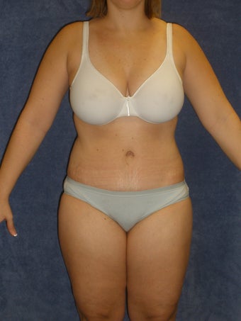 Tummy Tuck with Liposuction after 411003