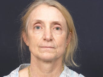 Facial rejuvenation before 140846