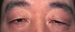 Eyelid Surgery before 154210