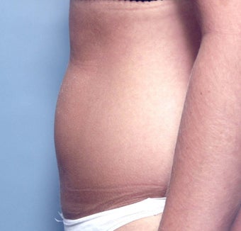 Slim Lipo before 137508