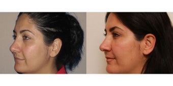 Facial Rejuvenation, non-surgical after 450125