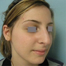 Rhinoplasty before 134004