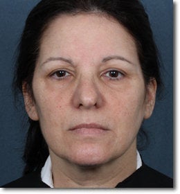 ZPL Peel Light Laser (Weekend Peel) Skin Rejuvenation before 624907