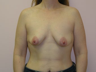 Breast Lift with Implants 312862