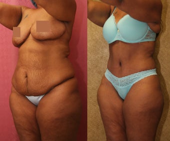 tummy tuck 304705