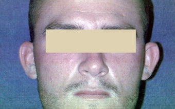 Ear Procedure before 89053