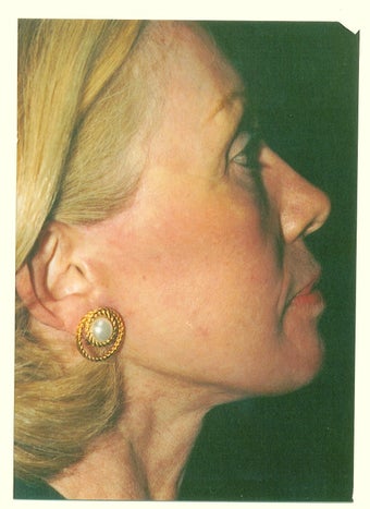Facelift after 257849